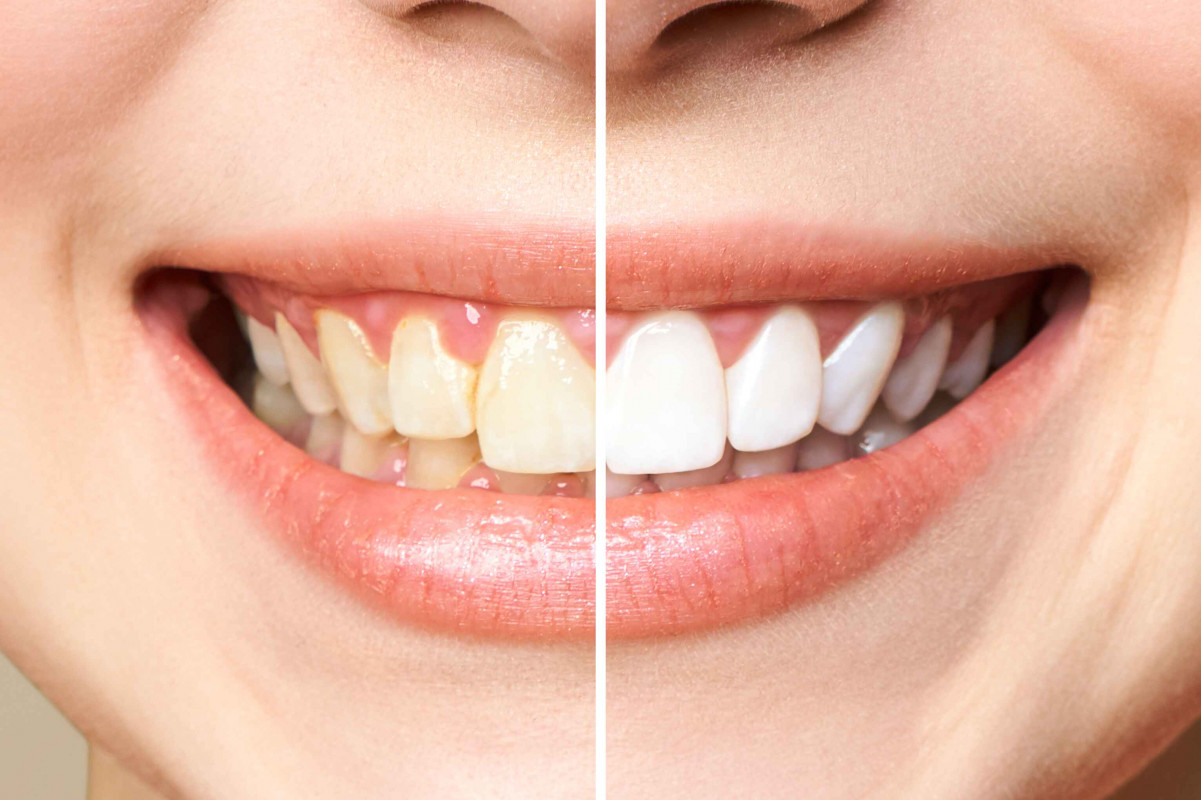 Teeth cleaning and polishing + tartar removal + fluoride application