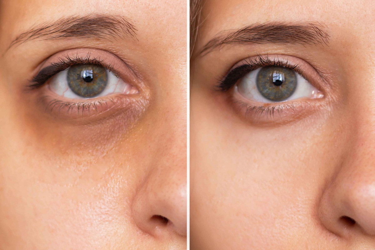 A package of 3 treatment sessions for dark circles under the eyes, Anuvial