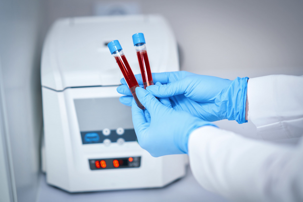 HOMA_IR insulin resistance test