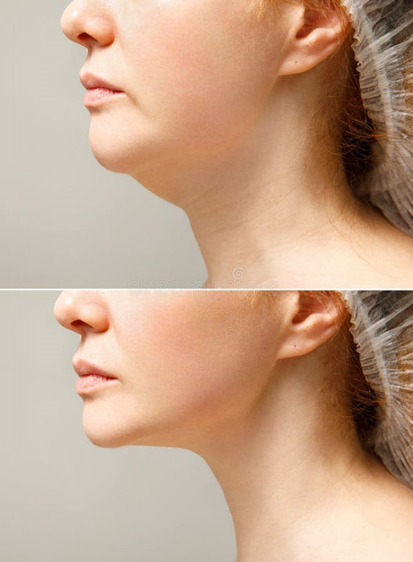 MESOTHERAPY FOR DOUBLE CHIN FAT